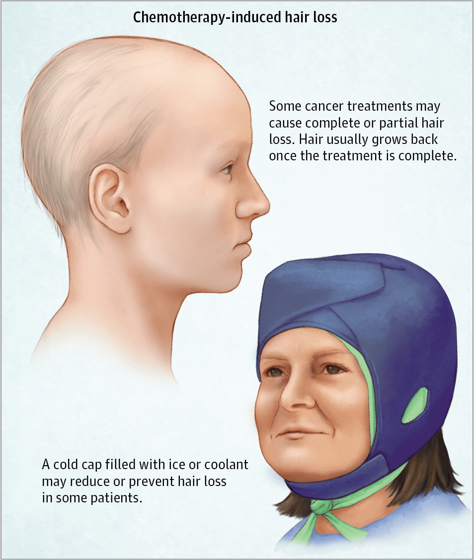Hair Loss Prevention From Chemotherapy https://www.hairlossmenwomen.com ...
