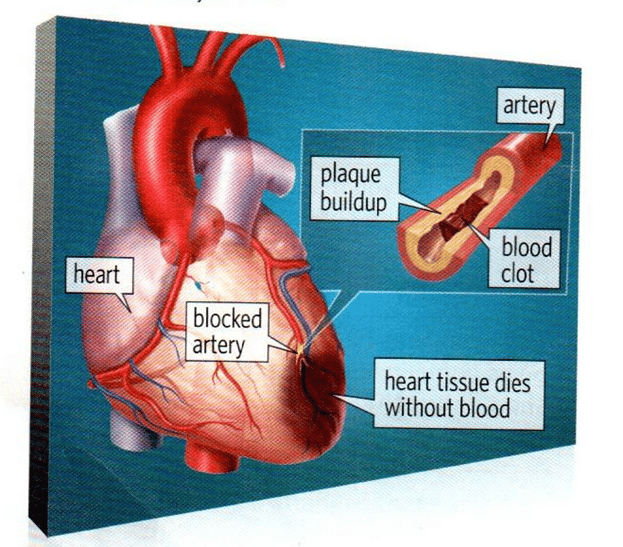 Angina and Heart Attack.