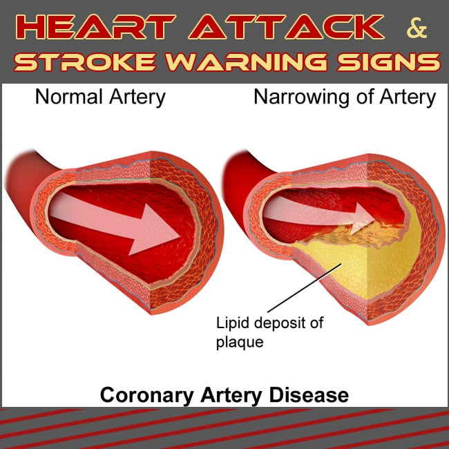 Heart Attack and Stroke Warning Signs