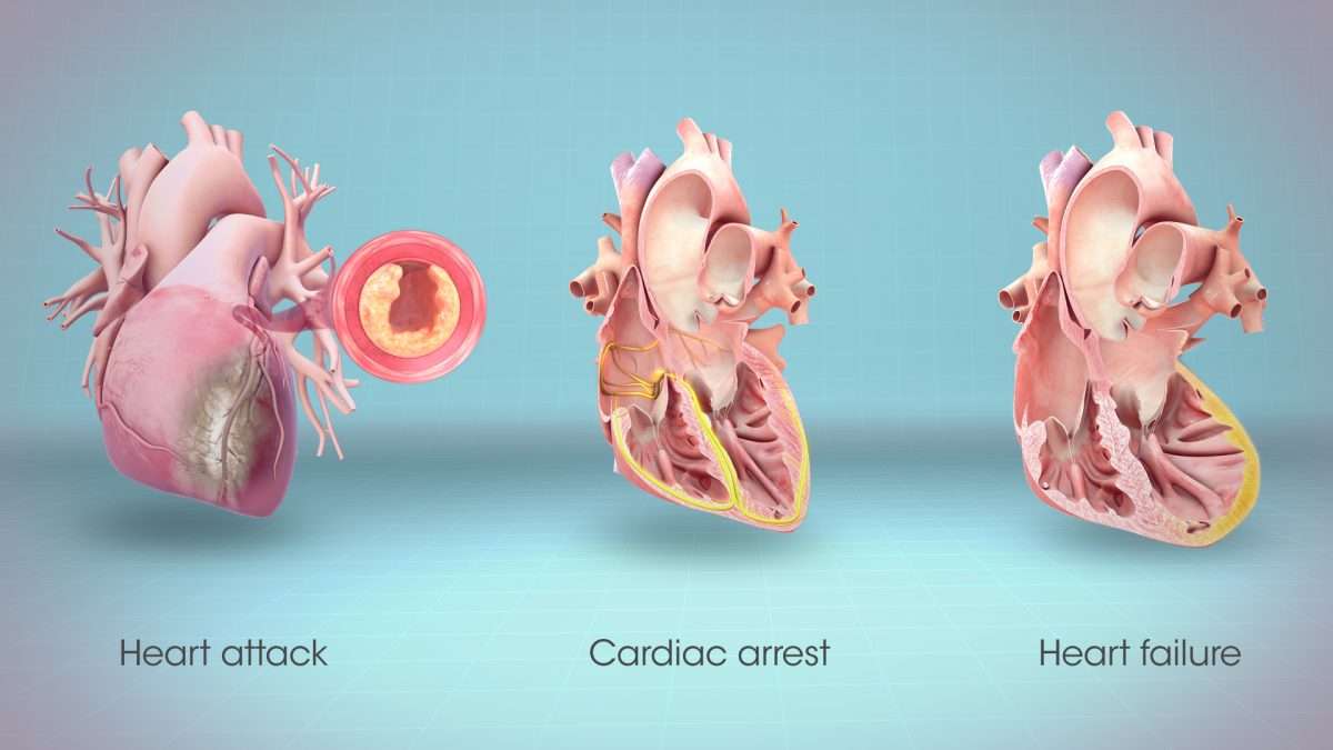 Heart Attack, Cardiac Arrest and Heart Failure..They are all different