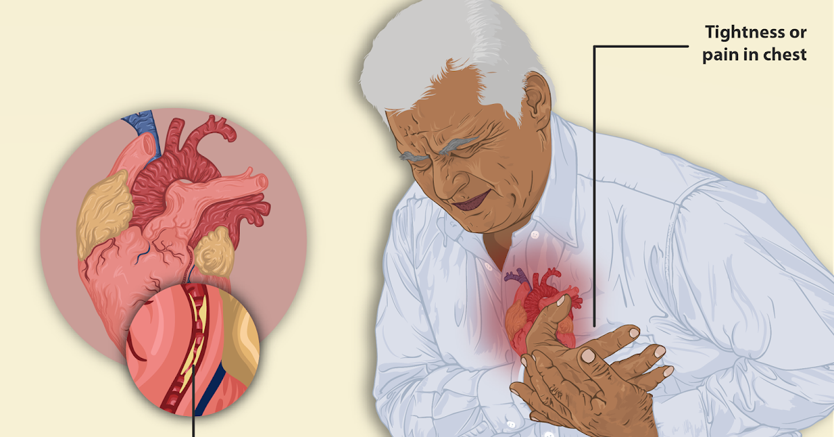 Heart attack: definition,Prevention,causes,Treatment ...