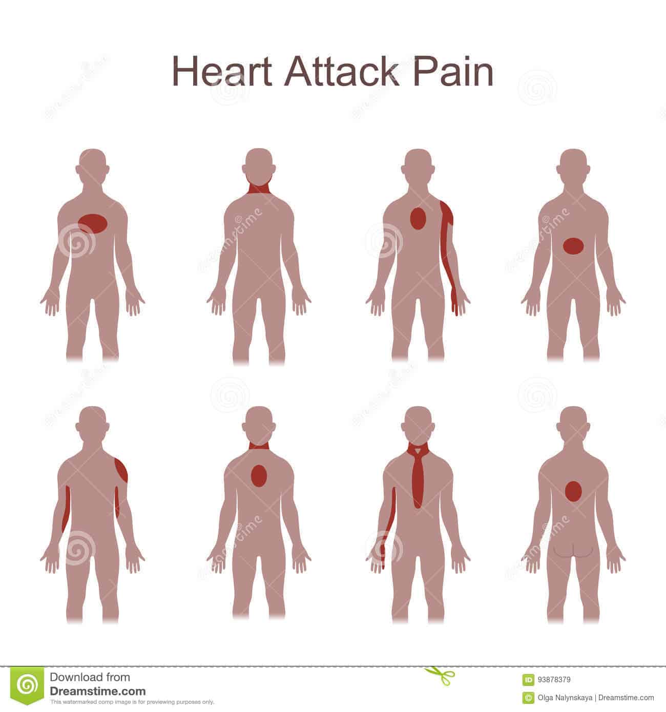 Heart Attack Pain Location stock vector. Illustration of attack