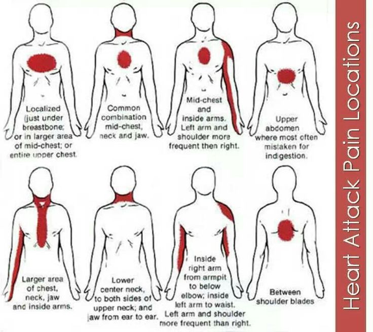 Heart attack pain locations