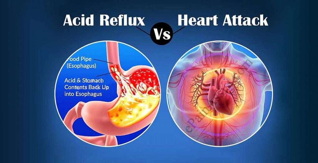 Heart Attack Versus Heartburn