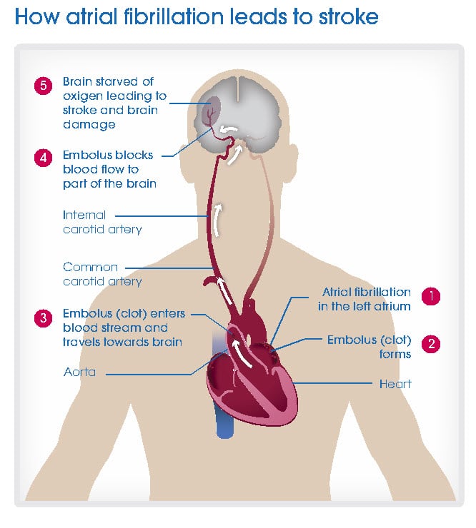 Heart Beating Too Fast or Slow? You May Have Atrial Fibrillation &  Be ...