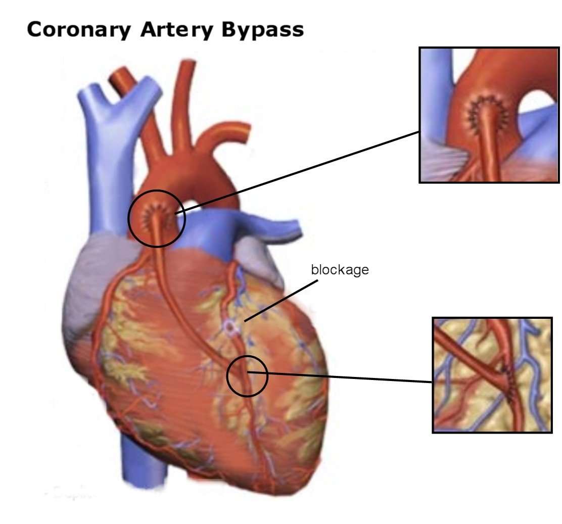 Heart Bypass Surgery at a Young Age ( what to expect )