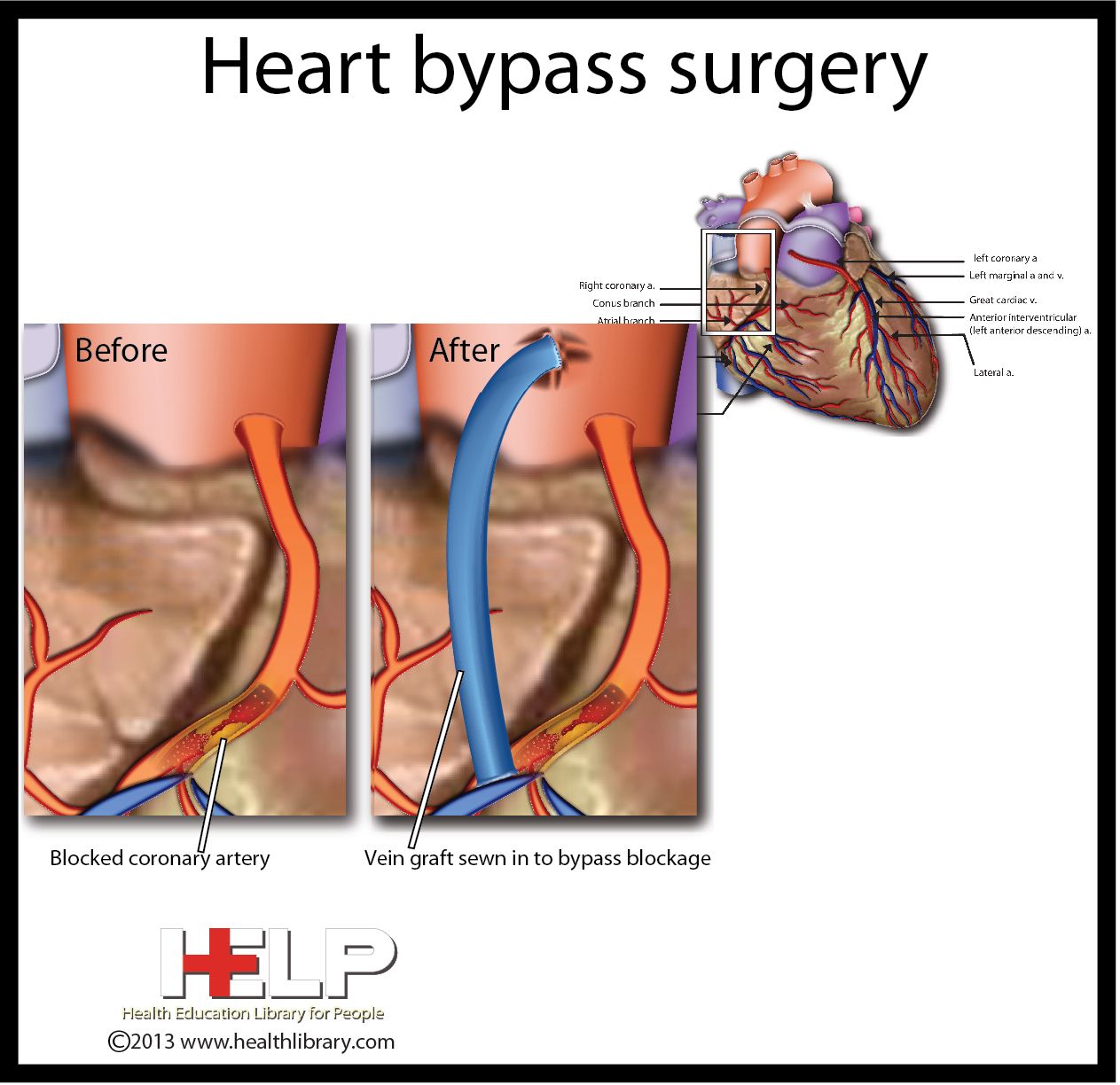 Heart Bypass Surgery