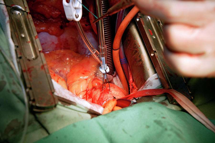 Heart Bypass Surgery Photograph by Antonia Reeve/science Photo Library