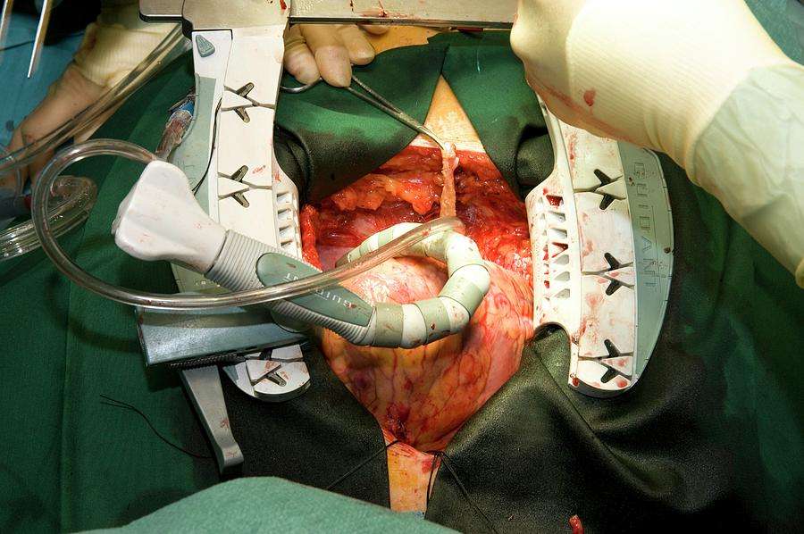 Heart Bypass Surgery Photograph by Dr P. Marazzi/science Photo Library