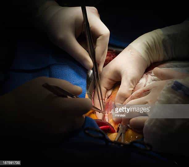 Heart Bypass Surgery Stock Photos and Pictures