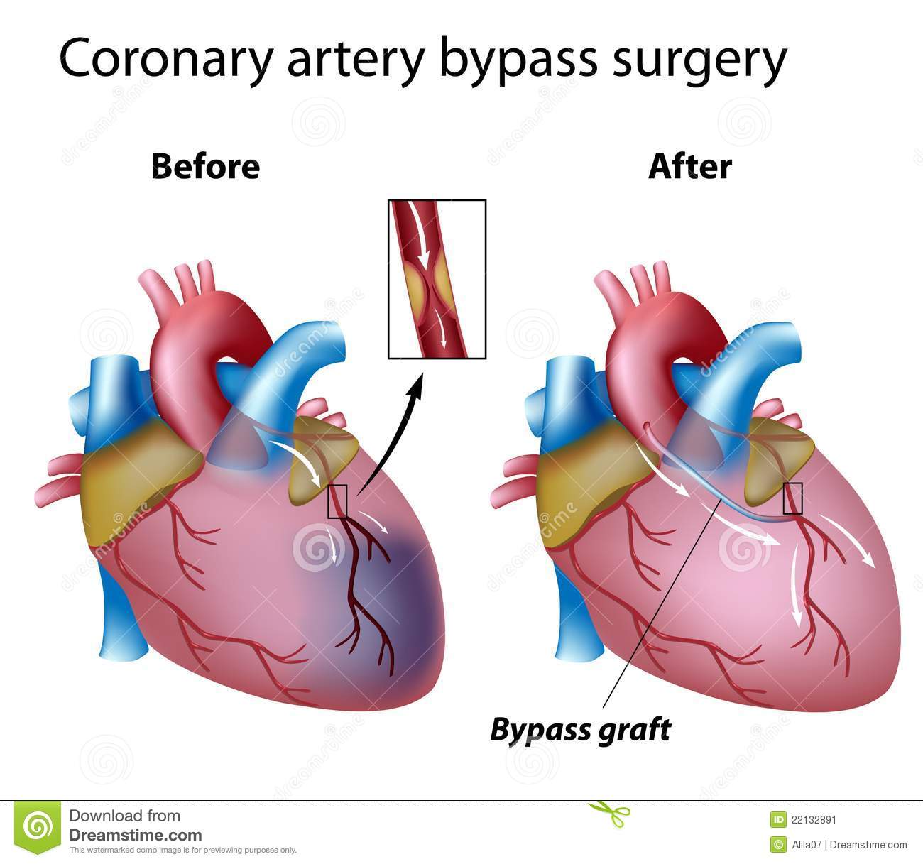Heart bypass surgery stock vector. Illustration of artery