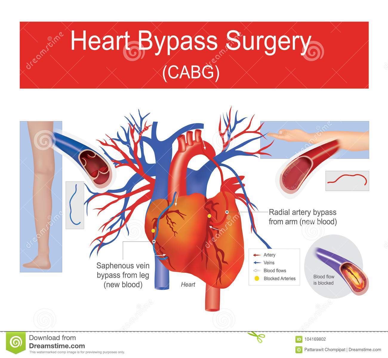 Heart bypass surgery. stock vector. Illustration of coronary