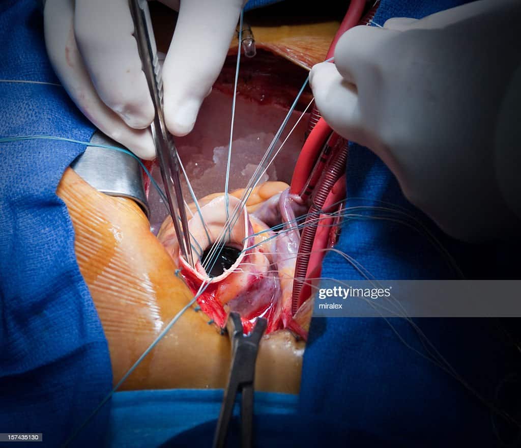 Heart Cardiac Surgery Aortic Valve Replacement High
