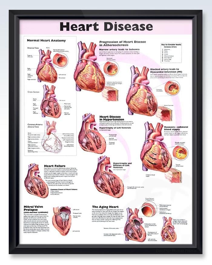Heart Disease Chart 20x26