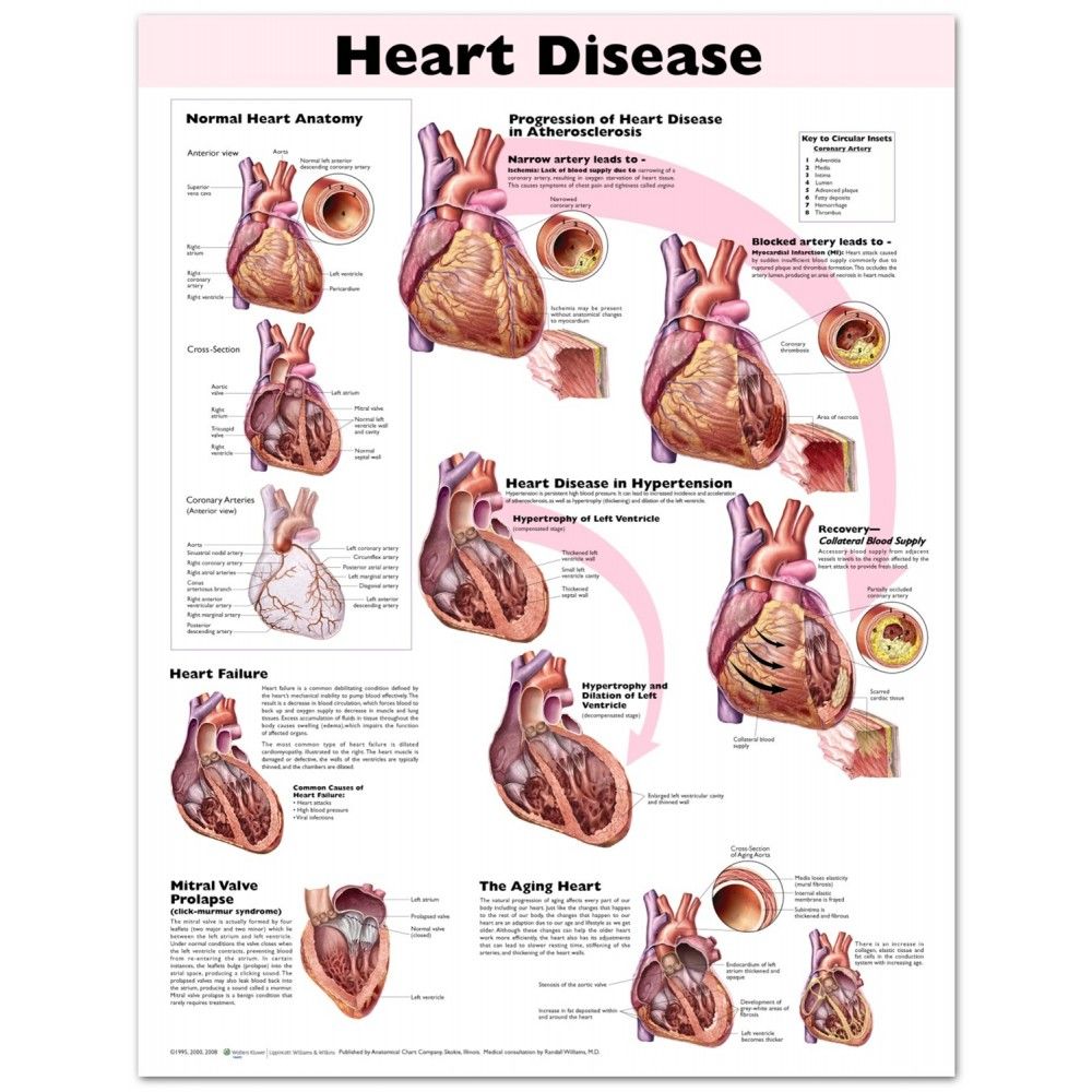 Heart Disease Chart / Poster