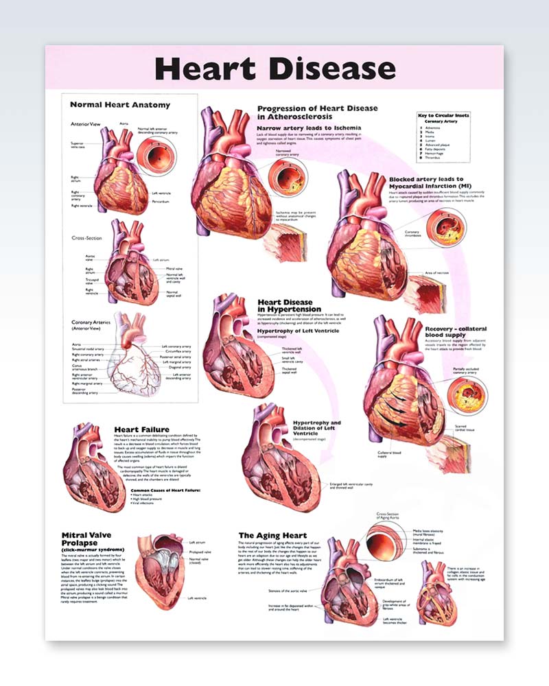 Heart Disease Exam Room Anatomy Poster  ClinicalPosters