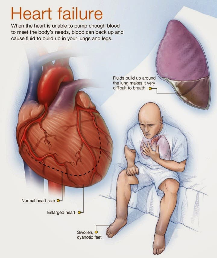 Heart Failure Causes, Symptoms And Signs