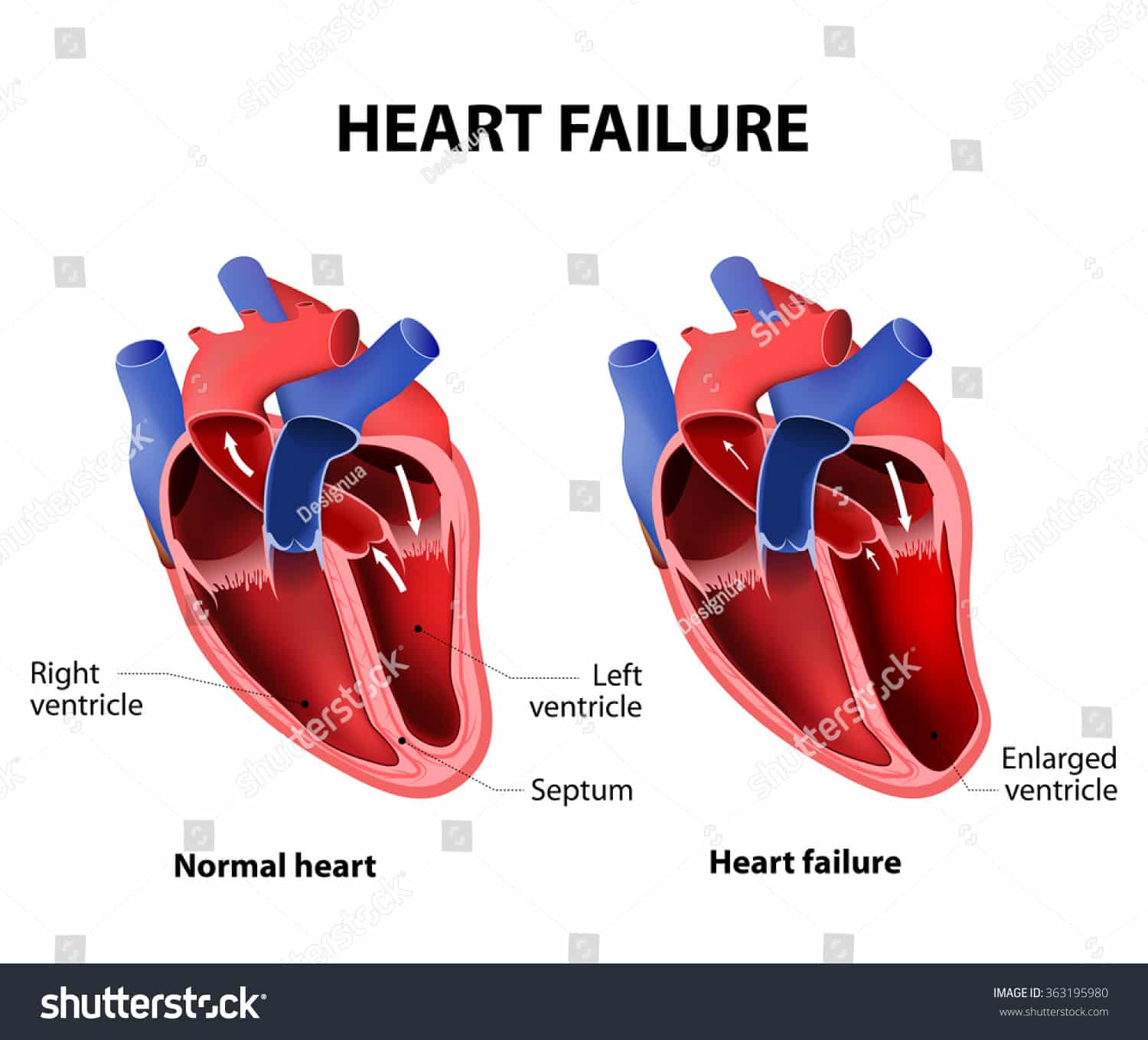 Heart Failure Congestive Heart Failure Stock Vector 363195980 ...