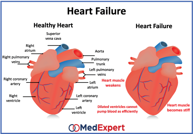 Heart failure diagnostics, treatment and symptoms