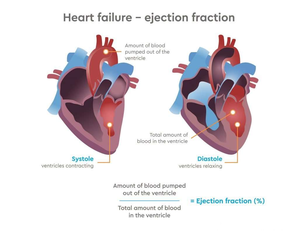 Сердечная недостаточность после. Heart failure. Chronic Heart failure. Normal ejection fraction. Heart failure 2020.