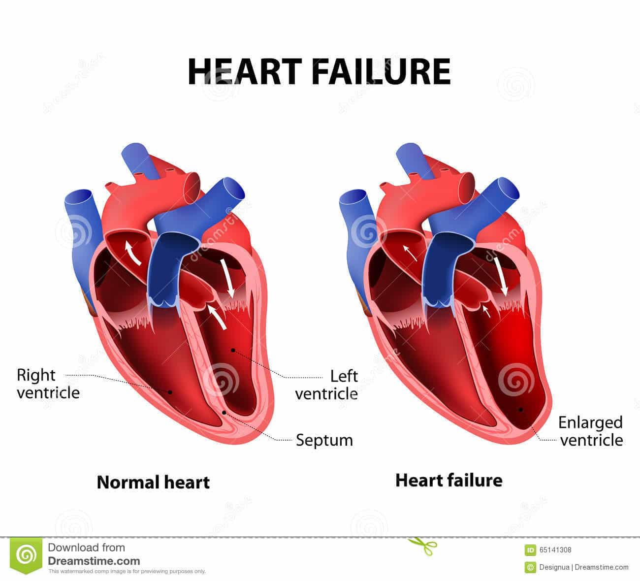 Heart failure stock vector. Illustration of dysfunction