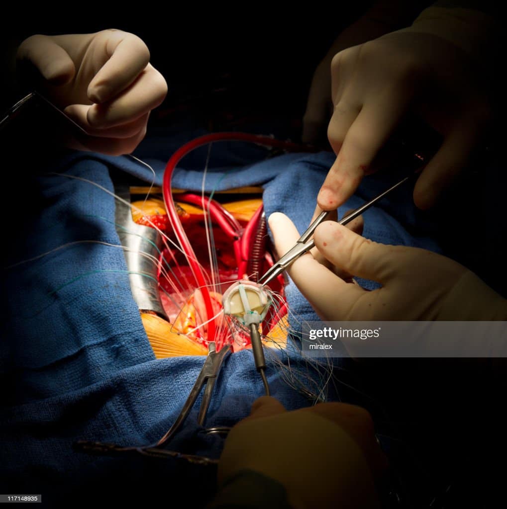 Heart Surgery Aortic Valve Replacement Stock Photo