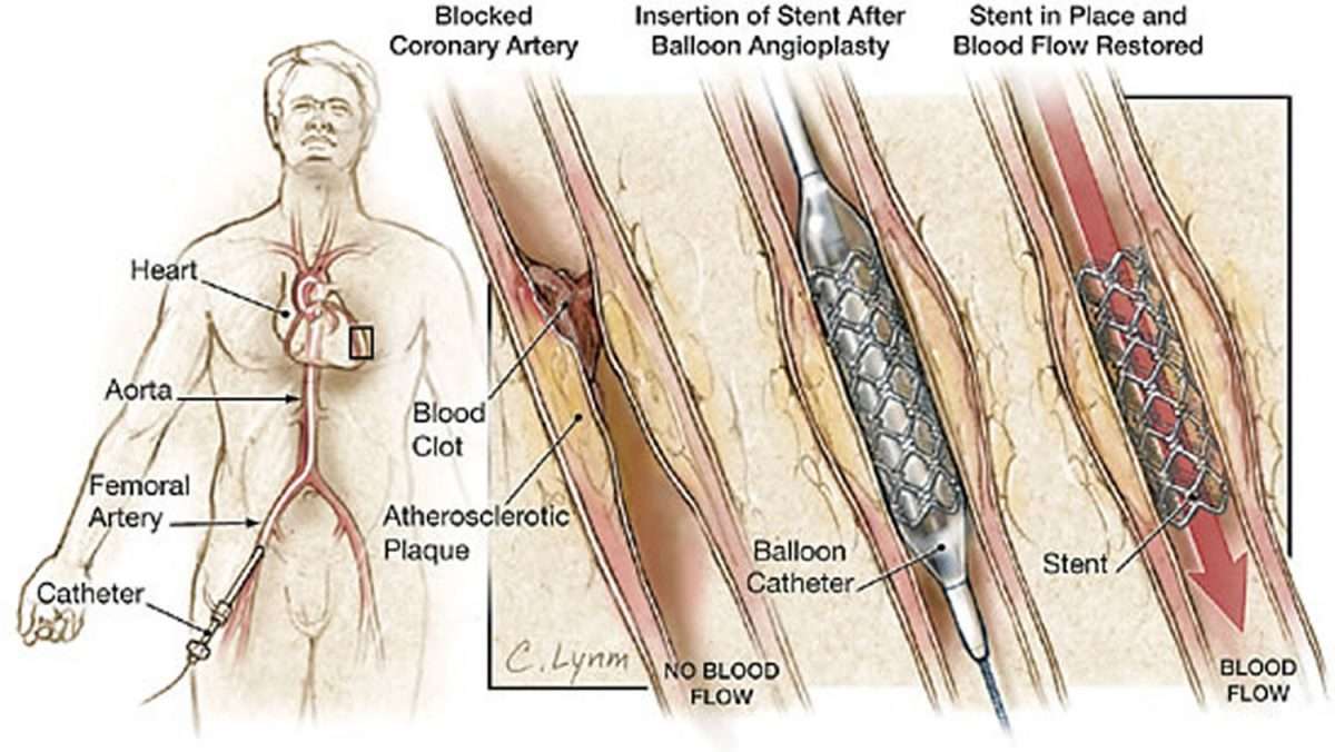 Heart Surgery Types