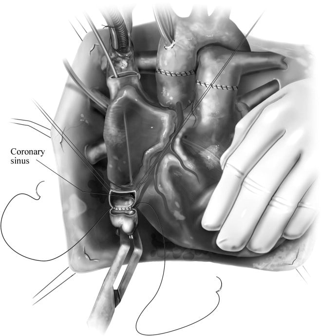 Heart Transplantation After Left Ventricular Assist Device