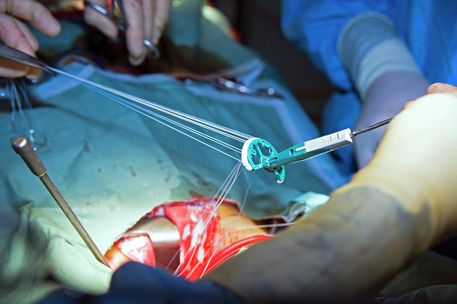 Heart Valve Repair Surgery Photograph by Antonia Reeve/science Photo ...
