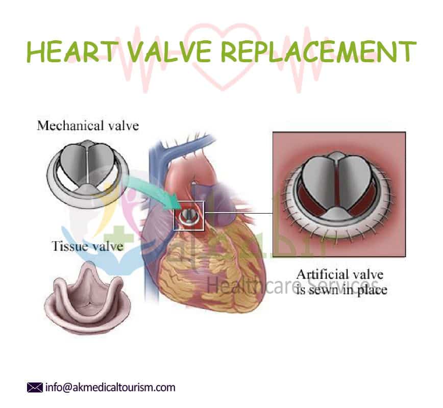 HEART VALVE REPLACEMENT COST IN INDIA