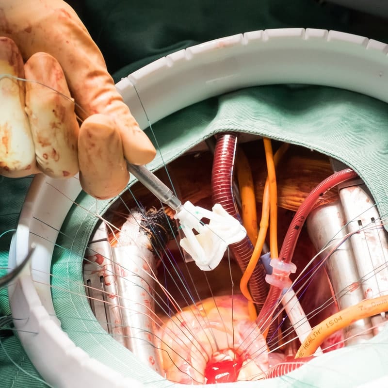 Heart valve replacement surgery cost in India  Vitamins Click