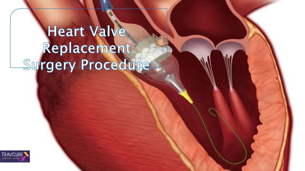 Surgery To Repair Heart Valve