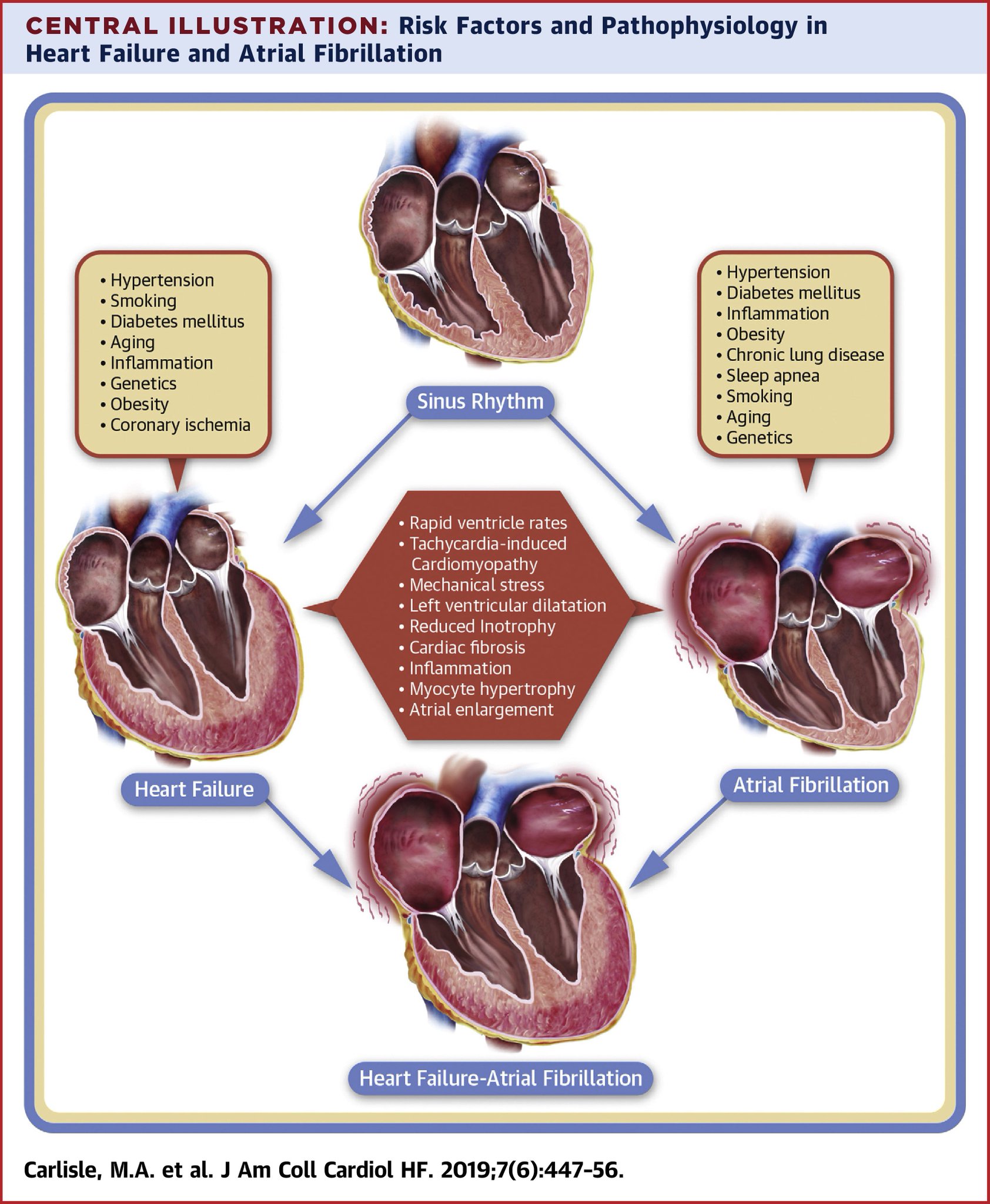 Hesi rn case study heart failure with atrial fibrillation