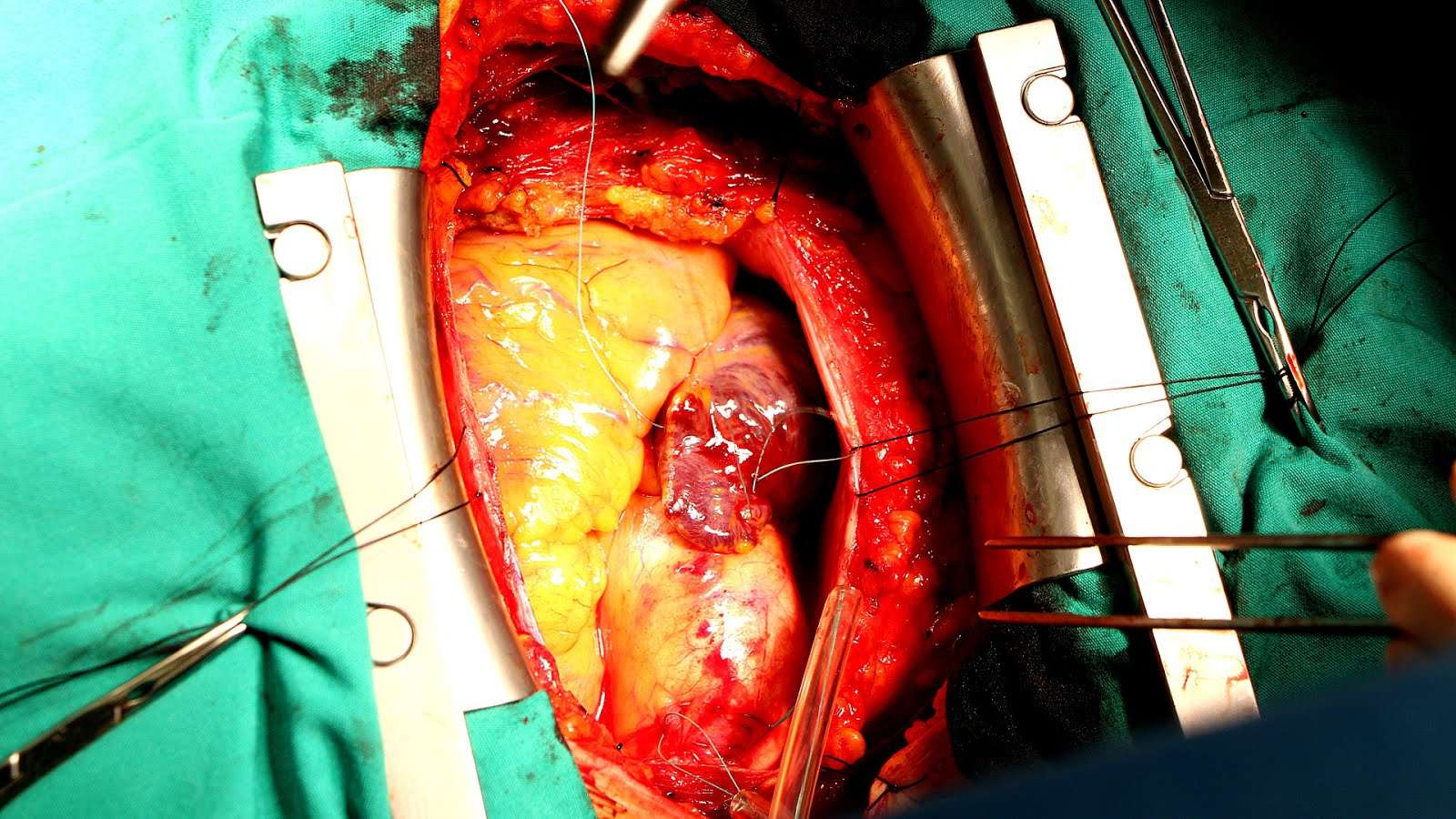 How Dangerous Is Open Heart Surgery