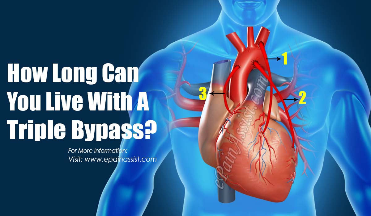 How Long Can You Live With A Triple Bypass