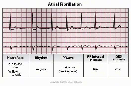 How to detect atrial fibrillation