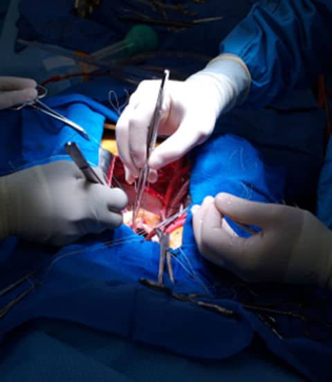 How to Perform Open Heart Surgery