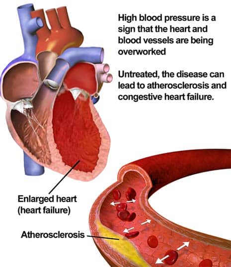 Hypertension is So Common That Almost Everyone is Affected at Some ...