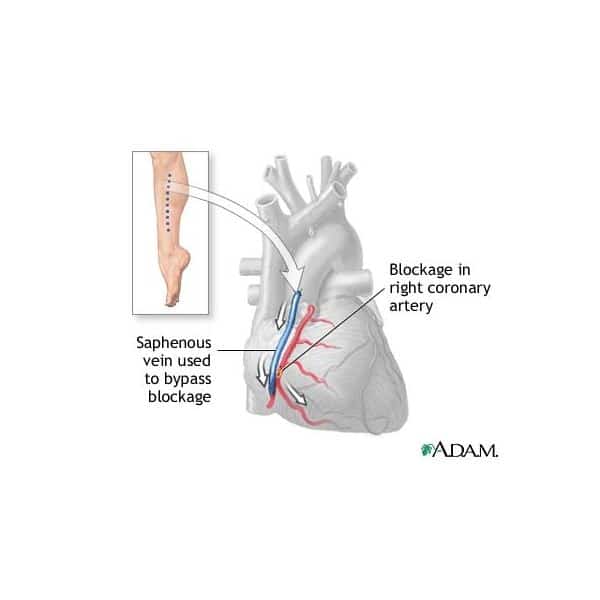 Igarni: Quadruple Bypass Open Heart Surgery Survival Rate