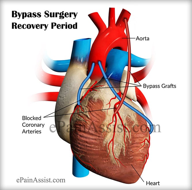 Igarni: Recovery From Open Heart Bypass Surgery