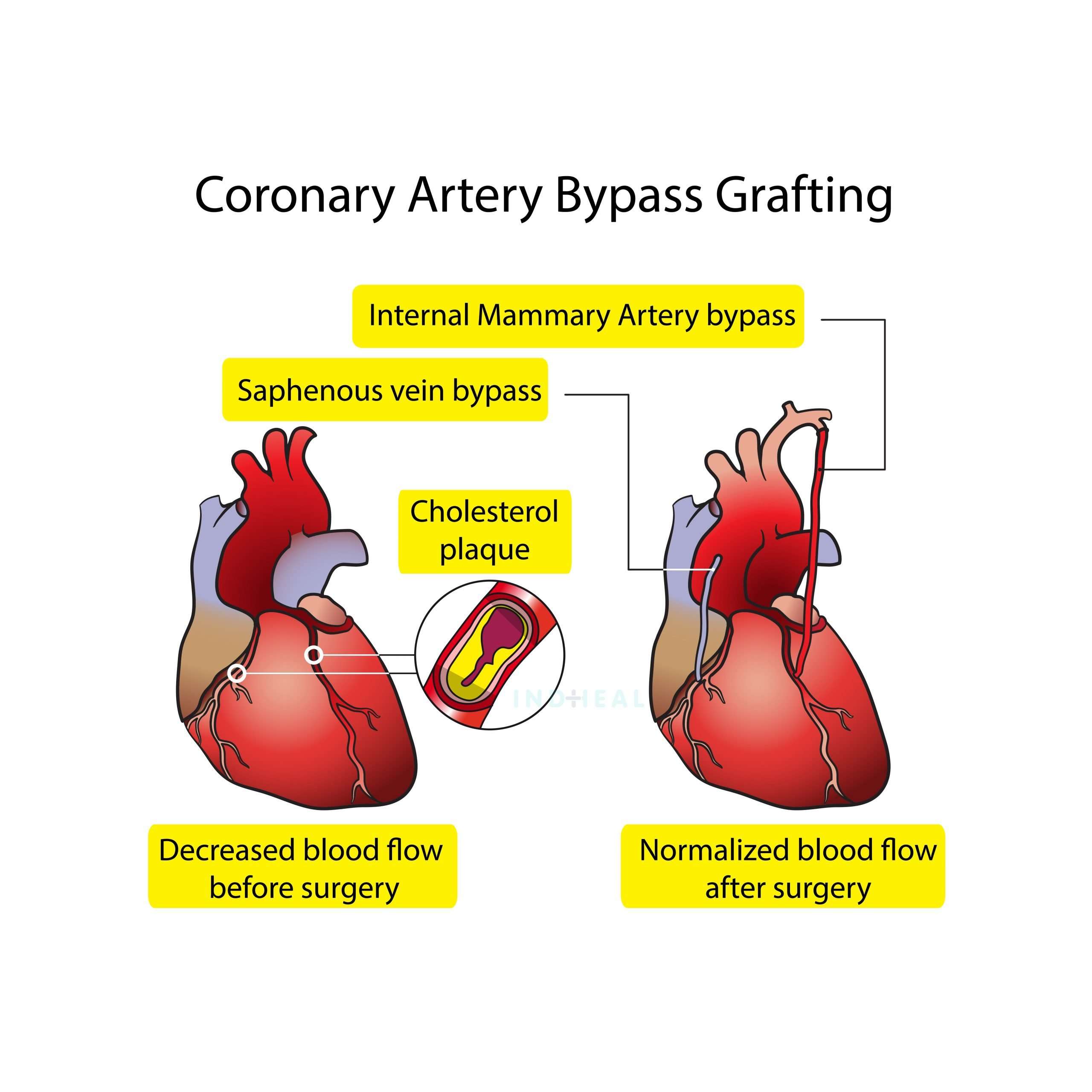 Igarni: Triple Bypass Surgery Cost In India