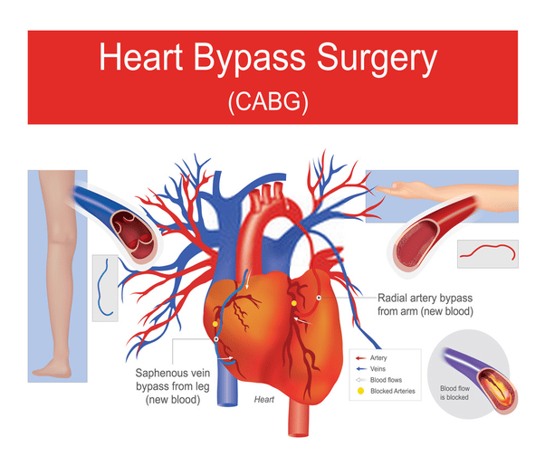 Igarni: Triple Bypass Surgery Recovery Timeline