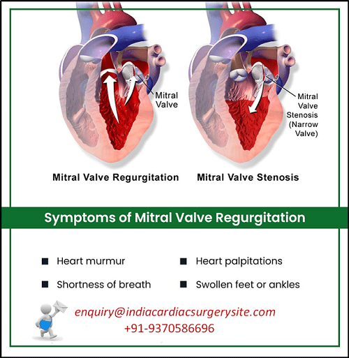 INDIAs TOP Hospitals and Surgeons for Mitral Valve Repair Surgery at ...