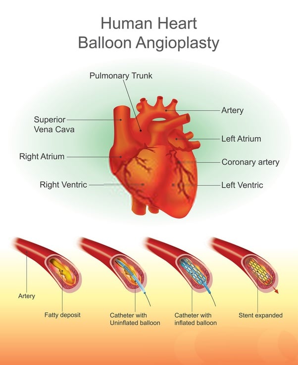 Is angioplasty a better option for an 80% blockage at the ostial left ...