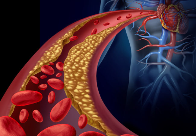 Is Heart Disease Curable?  Health Essentials from Cleveland Clinic