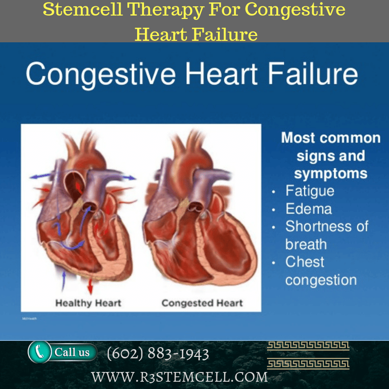 Is your Friend looking for Stem Cell Therapy For Congestive Heart ...