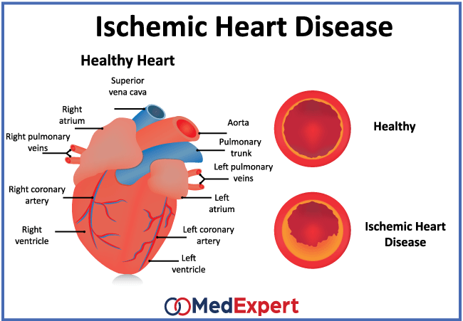 Ischemic heart disease. Stenting and coronary artery ...