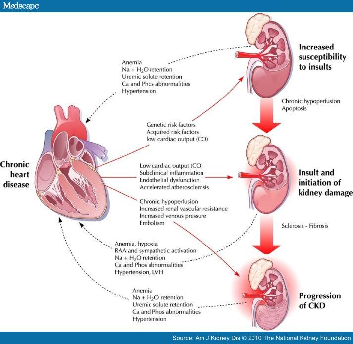 Kidney Failure Caused By Heart Failure