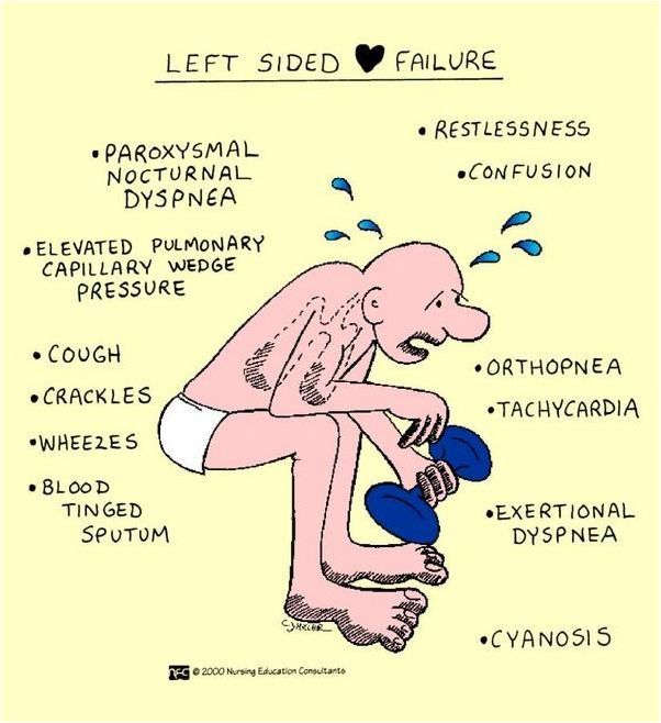 Left sided Heart Failure