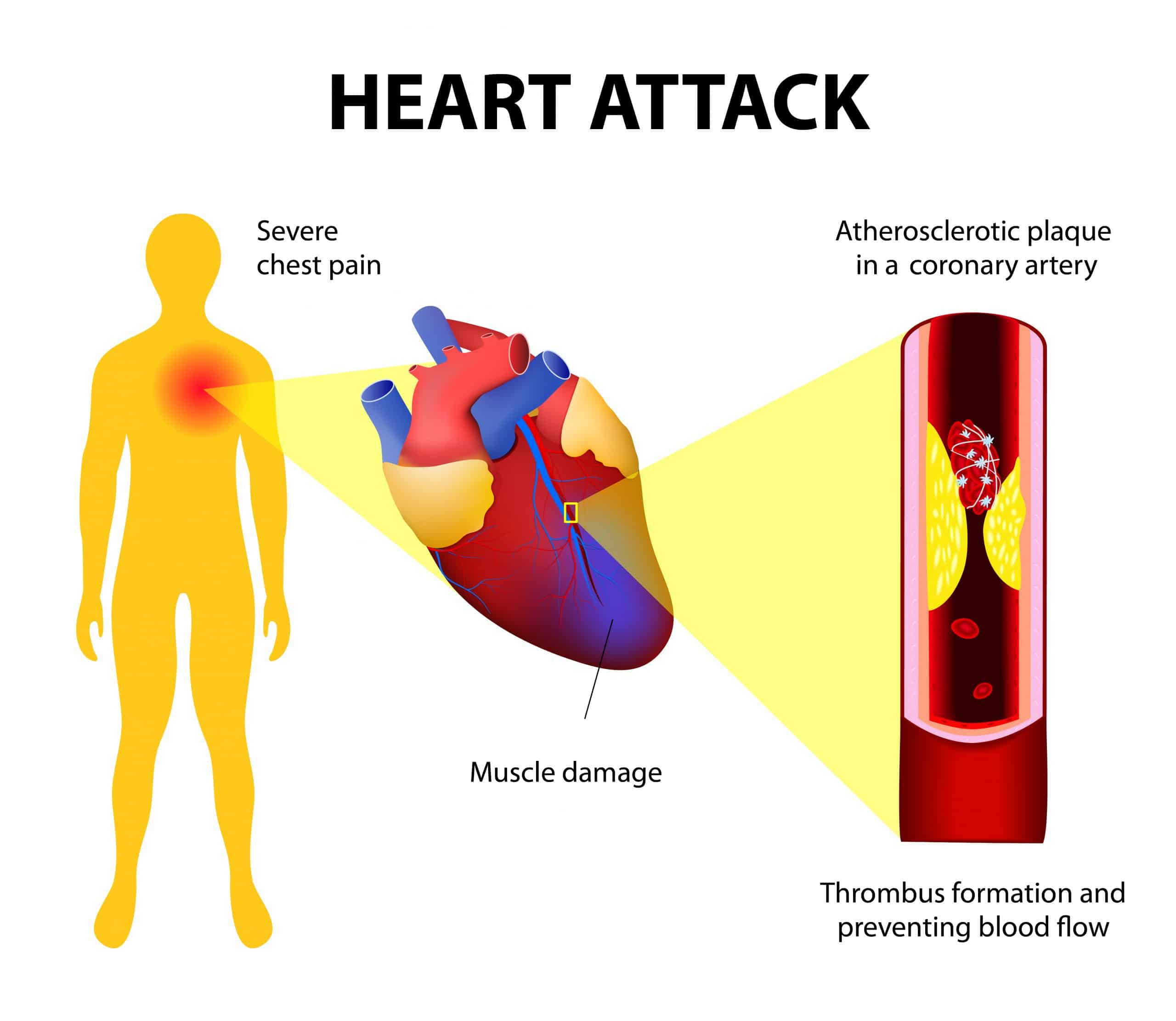 Medicare Underestimates Heart Attack Mortality Rates